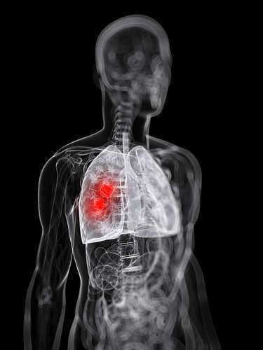 An Overview of Mesothelioma Litigation